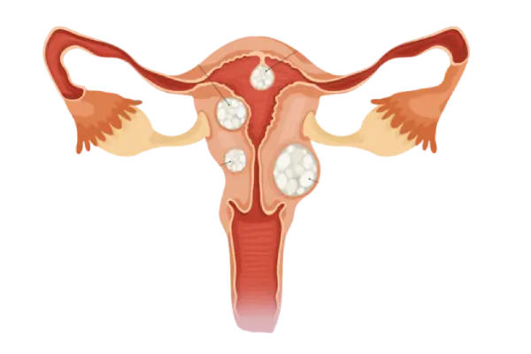 Dr. Rafael Alves - Tratamento para Miomectomia em Recife, Caruaru e Palmares